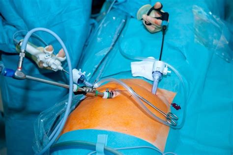 Abdominal hysterectomy .